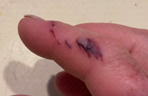 photo of iguana bite on finger