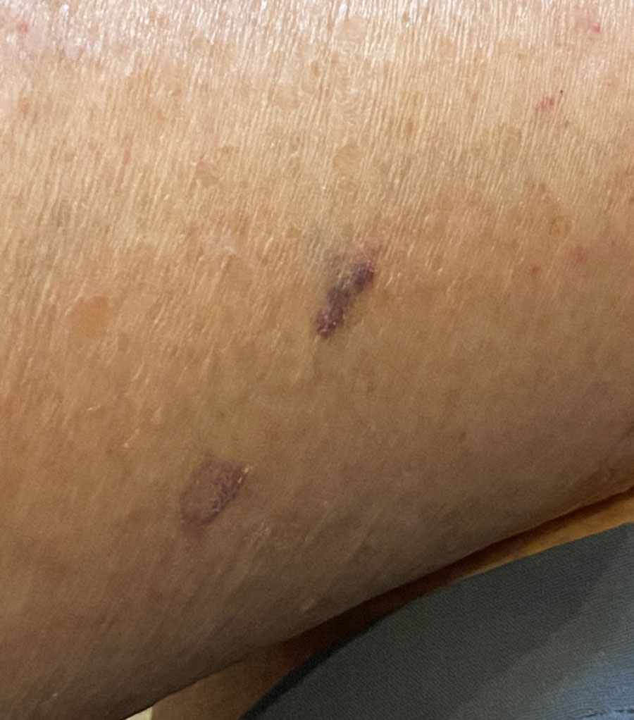 A close up of tortoise bite  marks on Elaine's leg, they are a deep red color and slightly raised. 