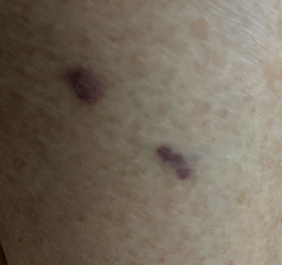 Another close-up of tortoise bites on Elaine. 